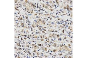 Immunohistochemistry of paraffin-embedded human gastric cancer using SNRPE Antibody. (SNRPE anticorps  (AA 1-92))