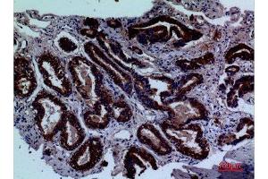 Immunohistochemistry (IHC) analysis of paraffin-embedded Human Prostate Cancer, antibody was diluted at 1:100. (LY9 anticorps  (Internal Region))