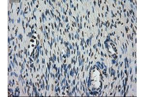 Immunohistochemical staining of paraffin-embedded Carcinoma of lung tissue using anti-STK39mouse monoclonal antibody. (STK39 anticorps)
