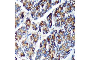 Immunohistochemistry of paraffin-embedded Human liver cancer using PLEKHB2 Rabbit pAb (ABIN7269415) at dilution of 1:100 (40x lens).