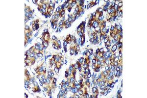 Immunohistochemistry of paraffin-embedded Human liver cancer using PLEKHB2 Rabbit pAb (ABIN7269415) at dilution of 1:100 (40x lens). (PLEKHB2 anticorps  (AA 1-222))