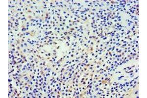 Immunohistochemistry of paraffin-embedded human breast cancer using ABIN7161360 at dilution of 1:100