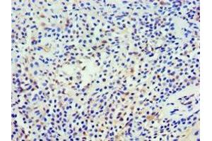 Immunohistochemistry of paraffin-embedded human breast cancer using ABIN7161360 at dilution of 1:100 (NCS1 anticorps  (AA 1-190))