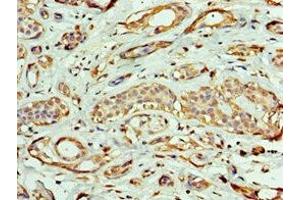 Immunohistochemistry of paraffin-embedded human breast cancer using ABIN7161953 at dilution of 1:100 (EXOG anticorps  (AA 144-368))