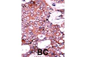 Formalin-fixed and paraffin-embedded human cancer tissue reacted with the primary antibody, which was peroxidase-conjugated to the secondary antibody, followed by AEC staining.