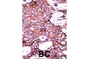 Formalin-fixed and paraffin-embedded human cancer tissue reacted with the primary antibody, which was peroxidase-conjugated to the secondary antibody, followed by AEC staining. (CDC25A anticorps  (pSer75))