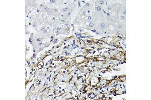 Immunohistochemistry of paraffin-embedded human liver using CD90/Thy1 Rabbit mAb (ABIN6129735, ABIN6148554, ABIN6148555 and ABIN7101405) at dilution of 1:100 (40x lens). (CD90 anticorps)