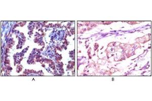 Immunohistochemical analysis of paraffin-embedded human metastatic adenocarcinoma(A) and stomach adenocarcinoma (B), showing cytoplasmic localization using Trim5α mouse mAb with AEC staining (A) and DAB staining(B). (TRIM5 anticorps)