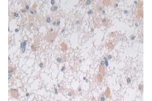 Detection of STX2 in Human Glioma Tissue using Polyclonal Antibody to Syntaxin 2 (STX2) (STX2 anticorps  (AA 8-262))