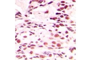 Immunohistochemical analysis of Lamin A/C staining in human breast cancer formalin fixed paraffin embedded tissue section. (Lamin A/C anticorps  (Center))