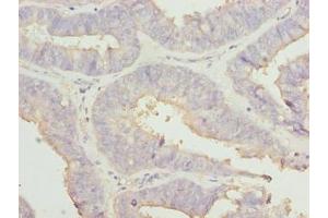 Immunohistochemistry of paraffin-embedded human endometrial cancer using ABIN7167001 at dilution of 1:100 (RABGEF1 anticorps  (AA 1-491))