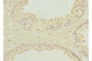 Immunohistochemistry of paraffin-embedded human prostate cancer using ABIN7151649 at dilution of 1:100