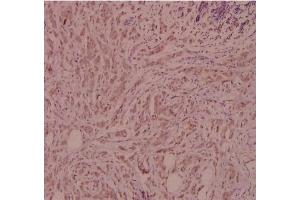 Immunohistochemistry (IHC) analyzes of CD124 / IL4R Antibody in paraffin-embedded human breast carcinoma tissue at 1/100. (IL4 Receptor anticorps)