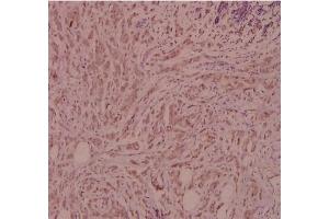 Immunohistochemistry (IHC) analyzes of CD124 / IL4R Antibody in paraffin-embedded human breast carcinoma tissue at 1/100.