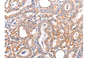 The image on the left is immunohistochemistry of paraffin-embedded Human thyroid cancer tissue using ABIN7128444(AOC1 Antibody) at dilution 1/15, on the right is treated with fusion protein. (DAO anticorps)