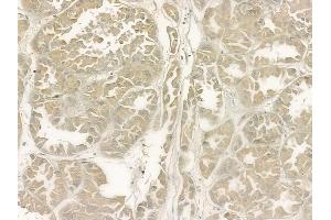 ABIN6266307 and ABIN6277426 at 1/100 staining human renal cell carcinoma by IHC-P. (PIBF1 anticorps  (C-Term))