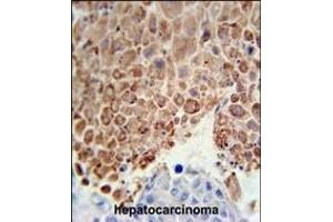 PHGDH Antibody (Center) (ABIN650767 and ABIN2839544) immunohistochemistry analysis in formalin fixed and paraffin embedded human hepatocarcinoma followed by peroxidase conjugation of the secondary antibody and DAB staining.
