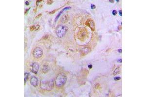 Immunohistochemical analysis of Osteopontin staining in human lung cancer formalin fixed paraffin embedded tissue section.