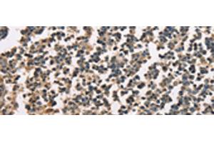 Immunohistochemistry of paraffin-embedded Human tonsil tissue using ZFYVE19 Polyclonal Antibody at dilution of 1:60(x200) (ZFYVE19 anticorps)