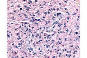 Anti-P2RY12 / P2Y12 antibody IHC of human Brain, Glioblastoma. (P2RY12 anticorps  (N-Term))