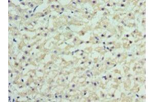 Immunohistochemistry of paraffin-embedded human liver cancer using ABIN7167852 at dilution of 1:100 (RBP4 anticorps  (AA 19-201))