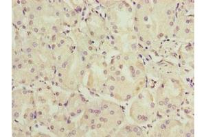 Immunohistochemistry of paraffin-embedded human gastric cancer using ABIN7174864 at dilution of 1:100 (C6orf141 anticorps  (AA 1-237))