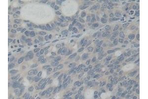 Detection of ABCB5 in Human Stomach cancer Tissue using Polyclonal Antibody to ATP Binding Cassette Transporter B5 (ABCB5)