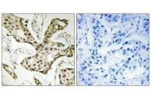 Immunohistochemistry analysis of paraffin-embedded human liver carcinoma tissue using TOP2A antibody.