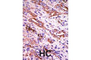 Formalin-fixed and paraffin-embedded human hepatocellular carcinoma tissue reacted with GRK1 polyclonal antibody  , which was peroxidase-conjugated to the secondary antibody, followed by DAB staining . (GRK1 anticorps  (C-Term))