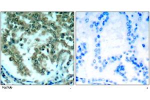 Immunohistochemical analysis of paraffin-embedded human lung carcinoma tissue using PRKCQ polyclonal antibody . (PKC theta anticorps)