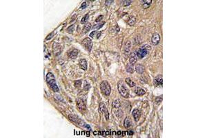 Formalin-fixed and paraffin-embedded human lung carcinomareacted with YARS polyclonal antibody , which was peroxidase-conjugated to the secondary antibody, followed by AEC staining. (YARS anticorps  (C-Term))