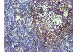 Immunohistochemical staining of paraffin-embedded Human lymphoma tissue using anti-NMT2 mouse monoclonal antibody. (NMT2 anticorps)