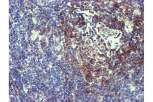 Immunohistochemical staining of paraffin-embedded Human lymphoma tissue using anti-NMT2 mouse monoclonal antibody.