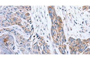 Immunohistochemistry of paraffin-embedded Human esophagus cancer tissue using NDUFA12 Polyclonal Antibody at dilution 1:50 (NDUFA12 anticorps)