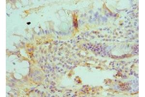 Immunohistochemistry of paraffin-embedded human colon cancer using ABIN7145627 at dilution of 1:100