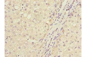 Immunohistochemistry of paraffin-embedded human liver cancer using ABIN7165661 at dilution of 1:100 (IWS1 anticorps  (AA 570-819))