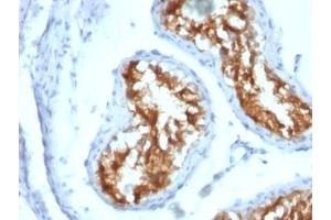 Formalin-fixed, paraffin-embedded human testicular carcinoma stained with Fascin antibody (FSCN1/417) (Fascin anticorps)