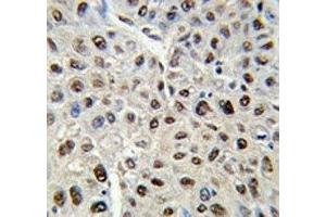 IHC analysis of FFPE human hepatocarcinoma stained with SS-B antibody