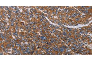 Immunohistochemistry of paraffin-embedded Human ovarian cancer tissue using PARP10 Polyclonal Antibody at dilution 1:30