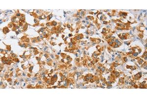 Immunohistochemistry of paraffin-embedded Human thyroid cancer using ARHGEF9 Polyclonal Antibody at dilution of 1:50 (Arhgef9 anticorps)