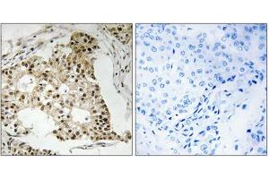 Immunohistochemical staining of paraffin-embedded human breast carcinoma tissue reacted with RARA (phospho S77) polyclonal antibody  at 1:50-1:100 dilution. (Retinoic Acid Receptor alpha anticorps  (pSer77))
