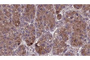 ABIN6273978 at 1/100 staining Human liver cancer tissue by IHC-P. (OR2L3/2L8 anticorps)