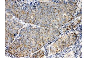 IHC testing of FFPE human lung cancer tissue with TECTA antibody at 1ug/ml. (TECTA anticorps  (AA 93-134))
