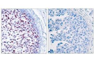 Immunohistochemical analysis of paraffin-embedded human breast carcinoma tissue using c-Jun(Phospho-Thr239) Antibody(left) or the same antibody preincubated with blocking peptide(right).