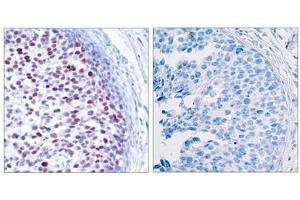 Immunohistochemical analysis of paraffin-embedded human breast carcinoma tissue using c-Jun(Phospho-Thr239) Antibody(left) or the same antibody preincubated with blocking peptide(right). (C-JUN anticorps  (pThr239))