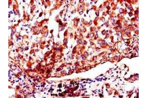 Immunohistochemistry of paraffin-embedded human lung cancer using ABIN7142915 at dilution of 1:100 (AKAP9 anticorps  (AA 71-191))