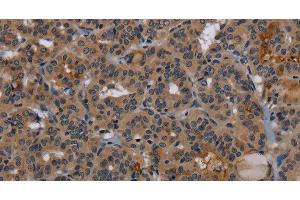Immunohistochemistry of paraffin-embedded Human thyroid cancer tissue using NPRL2 Polyclonal Antibody at dilution 1:50 (NPRL2 anticorps)