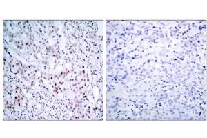 Immunohistochemical analysis of paraffin-embedded human breast carcinoma tissue using c-Jun (phospho- ser63) antibody (E011001). (C-JUN anticorps  (pSer63))