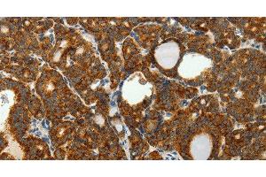 Immunohistochemistry of paraffin-embedded Human thyroid cancer tissue using SELENOM Polyclonal Antibody at dilution 1:50 (SELM anticorps)