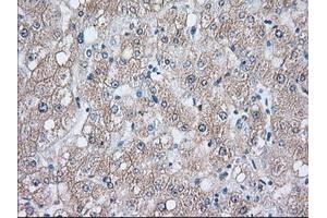Immunohistochemical staining of paraffin-embedded Human liver tissue using anti-HSPA1A mouse monoclonal antibody. (HSP70 1A anticorps)